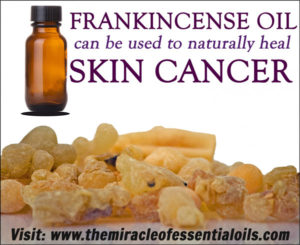 Can Frankincense oil cure cancer